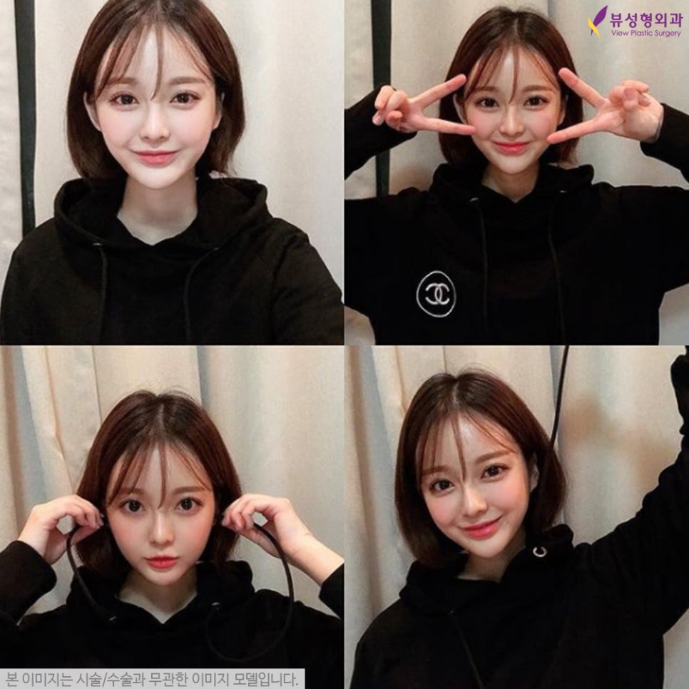쌍수후기 좋은 눈수술잘하는곳! l 뷰성형외과 관련 이미지 4