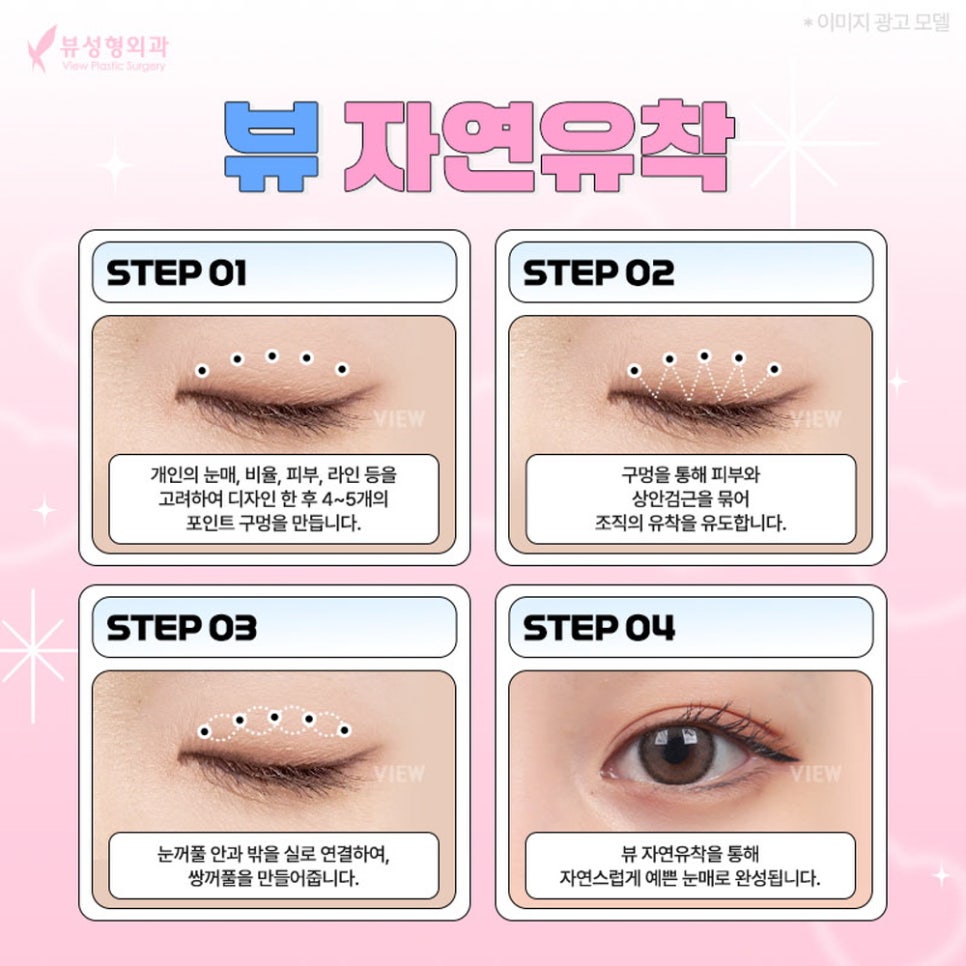 내게 맞는 눈성형 알아보기 관련 이미지 4