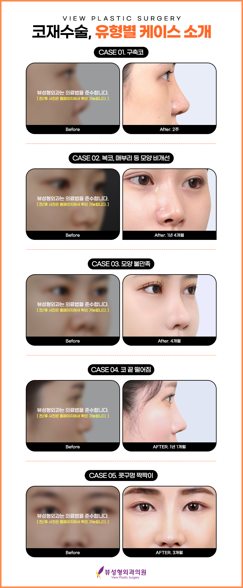 코재수술, 또 다시 실패하지 않으려면! 관련 이미지 4