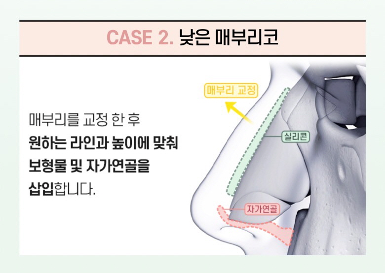 울퉁불퉁한 콧대를 매끈하게, 뷰성형외과 매부리코성형 관련 이미지 8