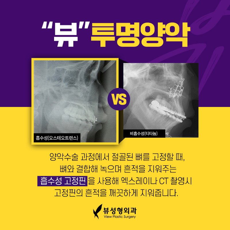 예뻐지는 수술? 양악수술의 올바른 정보 관련 이미지 6
