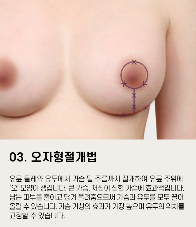 처진가슴수술 고민거리를 줄이고자 한다면 관련 이미지 12