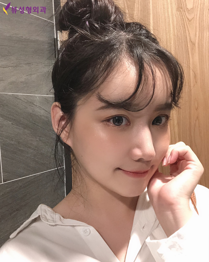 얼굴뼈성형 후 리프팅! 볼처짐 걱정말아요 관련 이미지 4