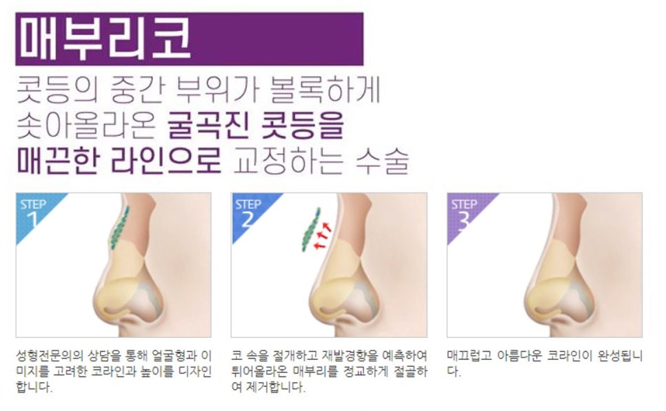 코성형, 개인별 유형에 적합한 수술방법은? 관련 이미지 6