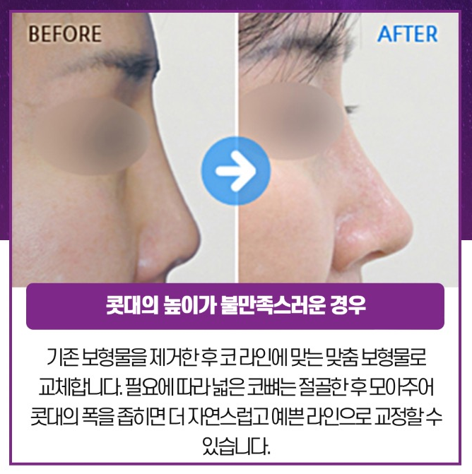 완성도 높은 코를 위한 체계적인 플랜, 코재수술 관련 이미지 4