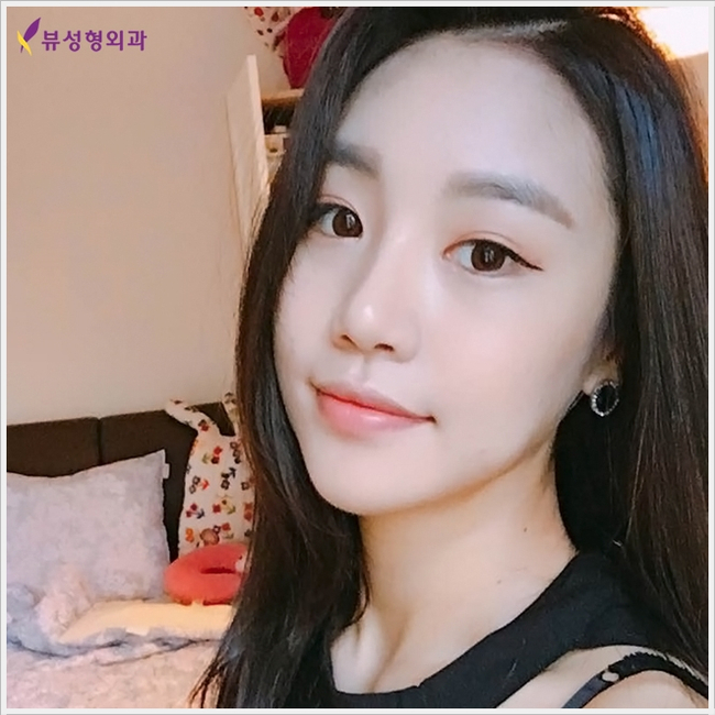 코성형 유의할 점은?(by 뷰성형외과) 관련 이미지 1