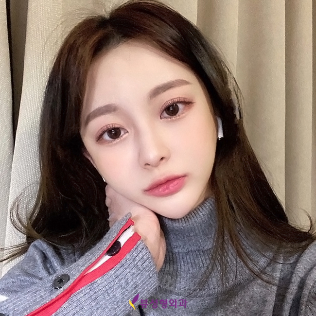 뷰성형외과 트임성형수술로 예쁨 충전 완료&hearts; 관련 이미지 8