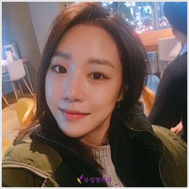 코성형 유의할 점은?(by 뷰성형외과) 관련 이미지 5