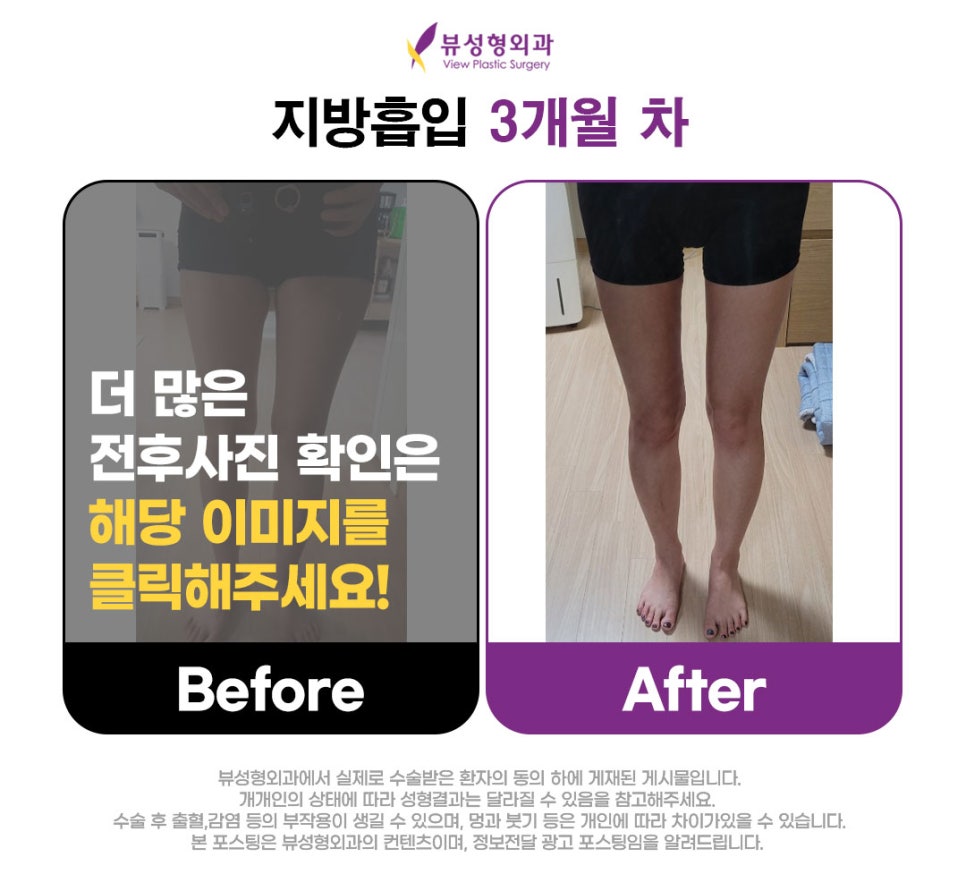 여자다이어트 스트레스 그만! +전후사진 관련 이미지 7