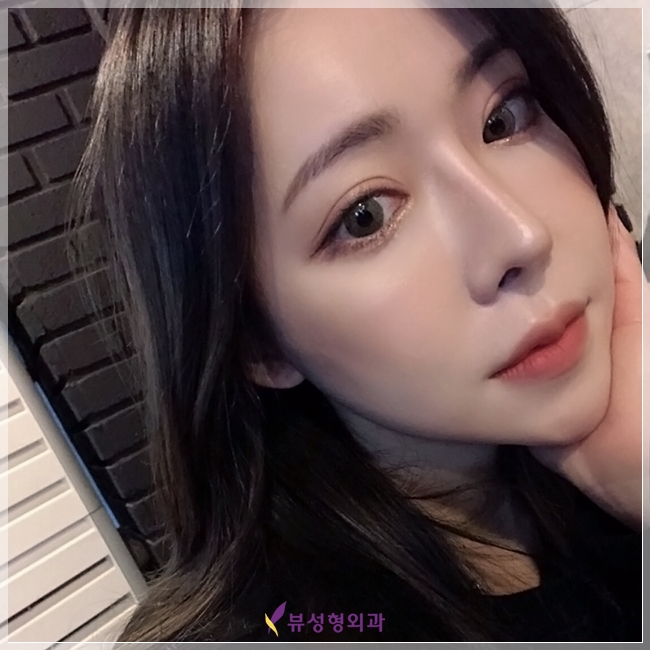 강남코재수술 하면 뷰성형외과지★ 관련 이미지 5