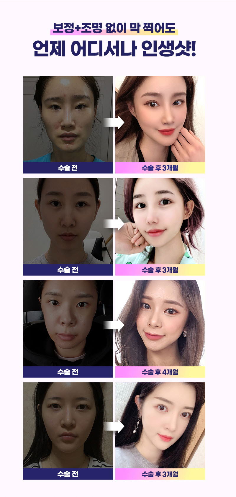 뒤트임가격 만큼 중요한 부분 관련 이미지 2