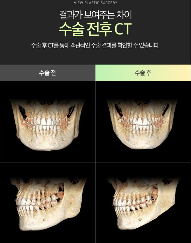 사각턱수술잘하는곳 뷰성형외과 긴곡선사각턱수술로 변화된 모습 관련 이미지 6