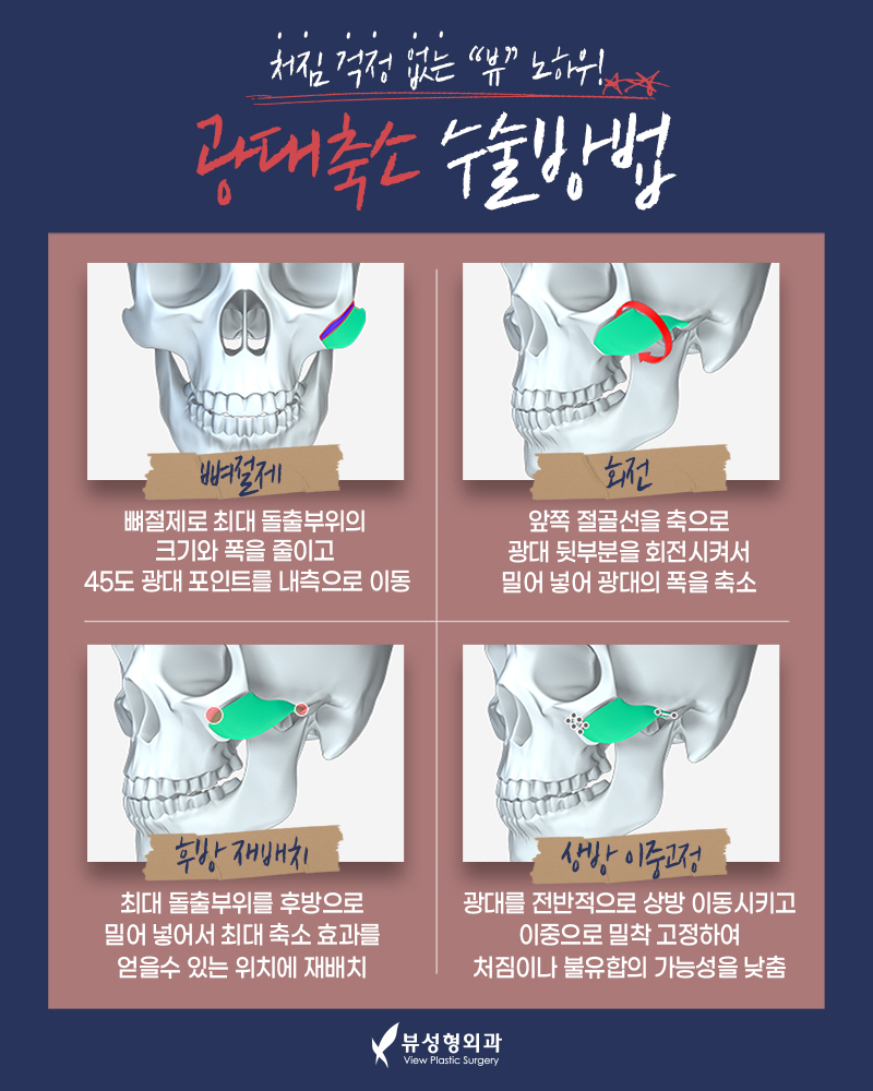 얼굴형의 밸런스를 맞춰주는 안면윤곽수술 관련 이미지 5