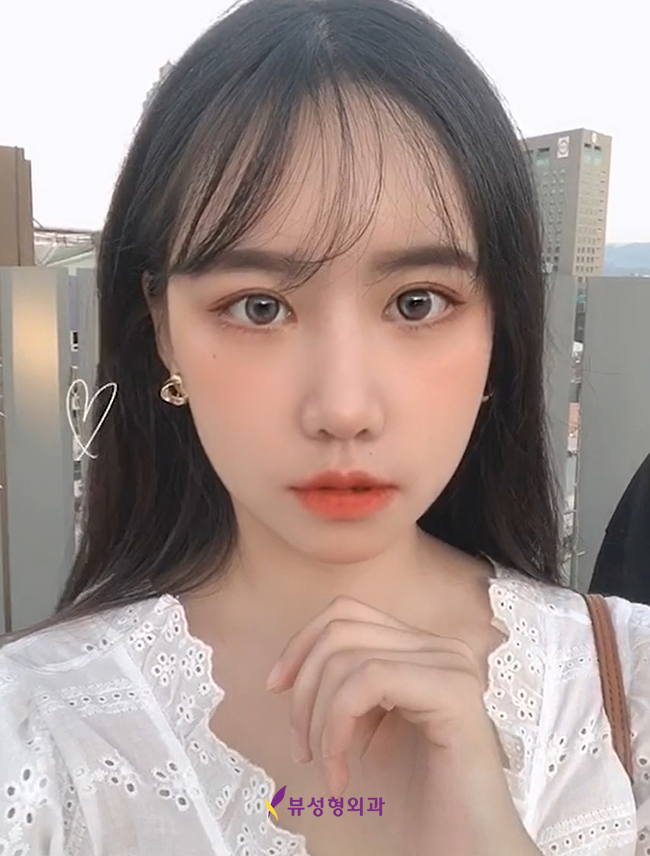 눈밑지방재배치 환해지는 인상 관련 이미지 4
