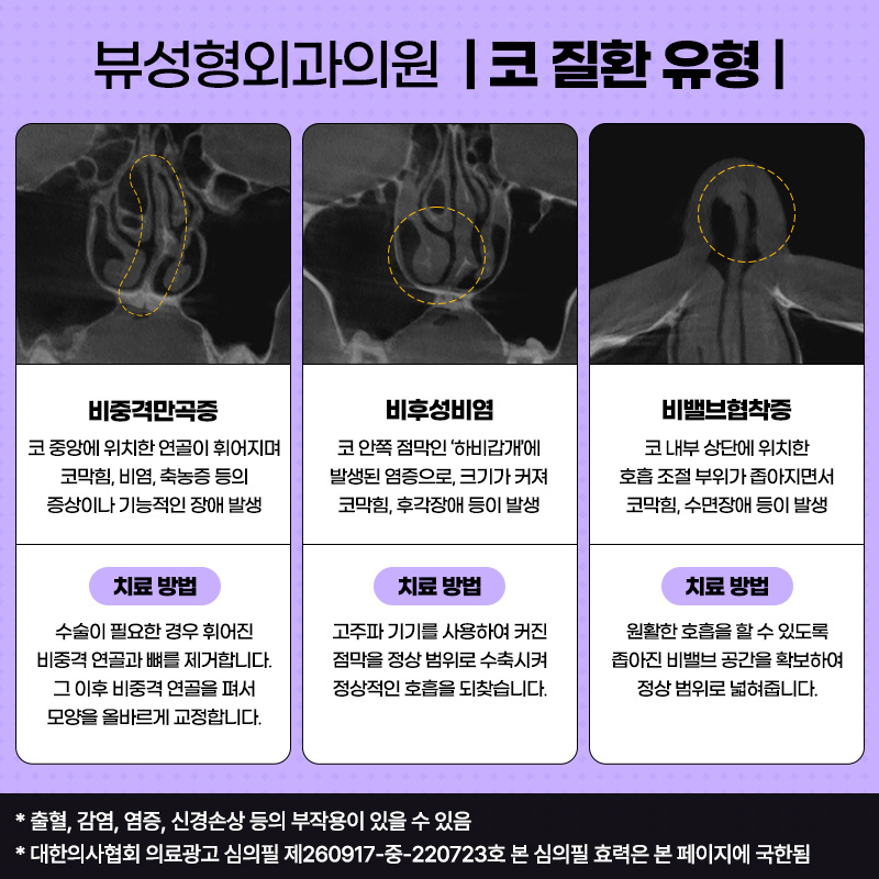 예쁘고 건강한 코, 비염치료와 코성형을 동시에 관련 이미지 2
