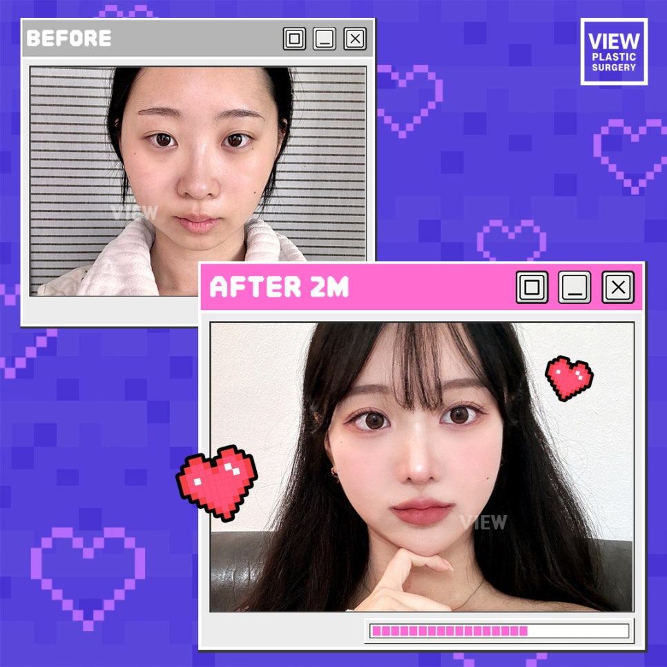 재수술만 4번째..이게 맞아? I 재수술 Q&A 관련 이미지 2