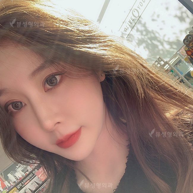 쌍꺼풀수술 나한테 적합한 수술방법은? 관련 이미지 1