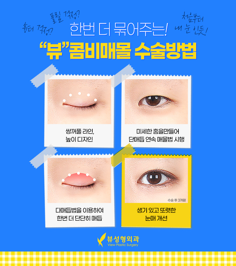 쌍꺼풀매몰법, 뷰에서 빠른 회복까지! 관련 이미지 5