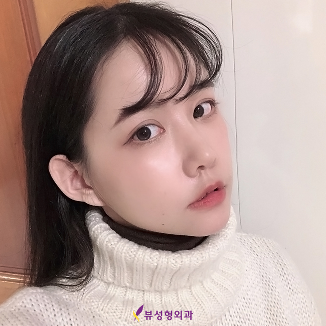 쌍꺼풀수술 나한테 적합한 수술방법은? 관련 이미지 3