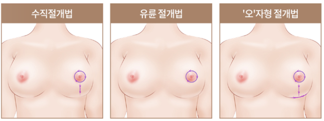 자연스런 가슴성형, 본인에게 적합한 보형물 및 절개방법 선택 중요 관련 이미지 10