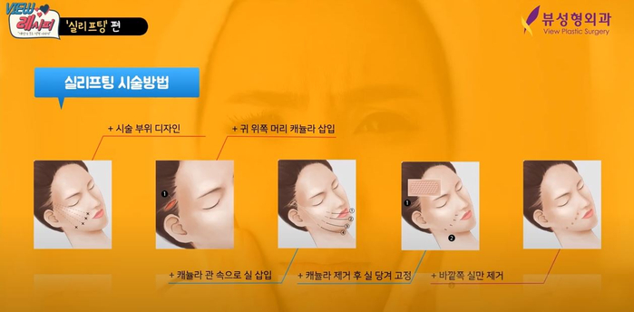 실리프팅 VS 안면거상술, 피부 상태에 맞는 맞춤리프팅 관련 이미지 8