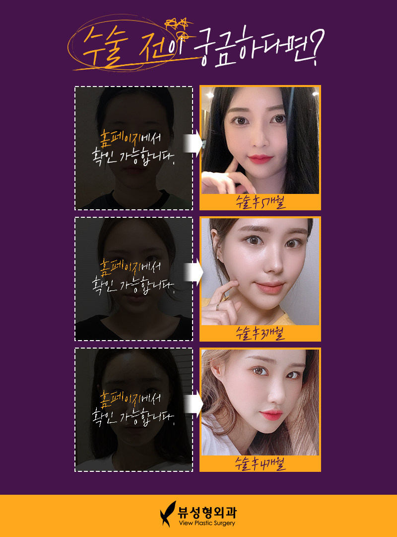 내게 맞는 눈성형을 위한 수술방법 관련 이미지 12