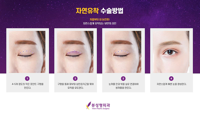 내게 맞는 눈성형을 위한 수술방법 관련 이미지 5