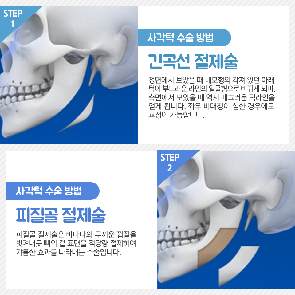 자연스럽게 윤곽잘하는곳 뷰성형외과 관련 이미지 6