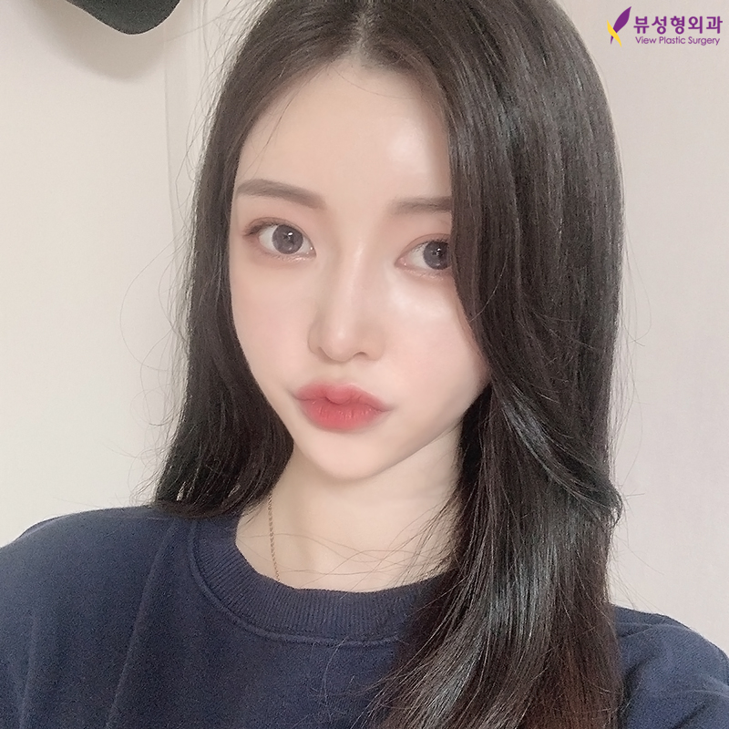 얼굴형의 밸런스를 맞춰주는 안면윤곽수술 관련 이미지 2