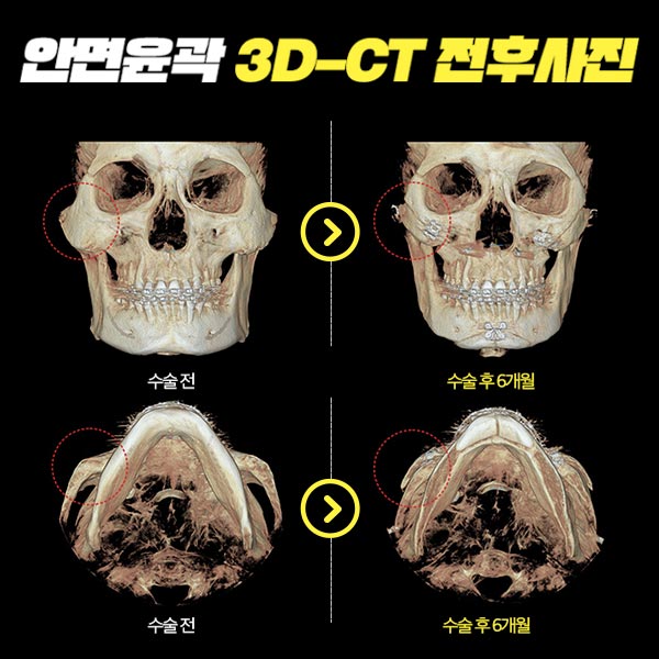 남자안면윤곽수술 의 핵심은! 관련 이미지 8