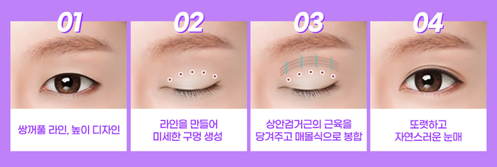 나만의 눈성형을 위한 수술방법 알아보기 관련 이미지 12