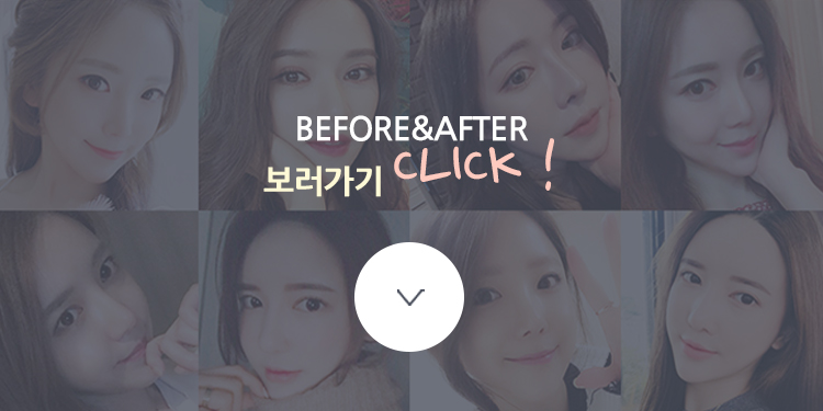 지방이식으로 동안얼굴 완성! 관련 이미지 4