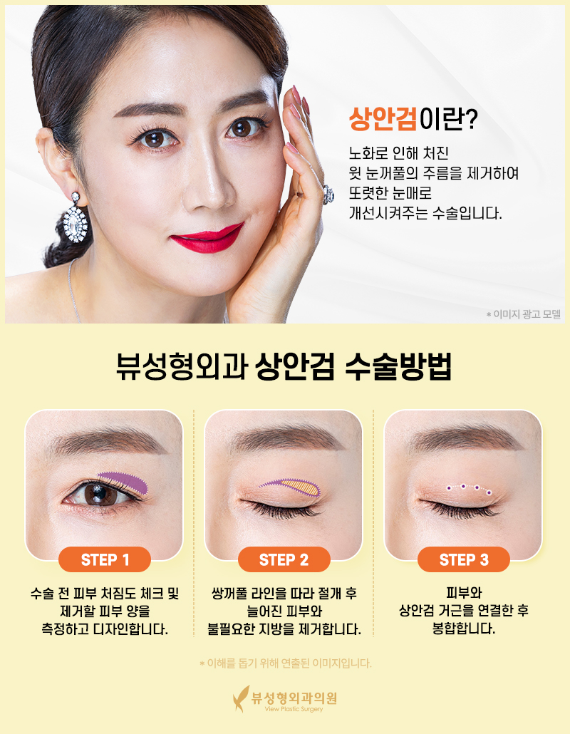 처지고 주름진 피부를 개선하는 동안성형 관련 이미지 6