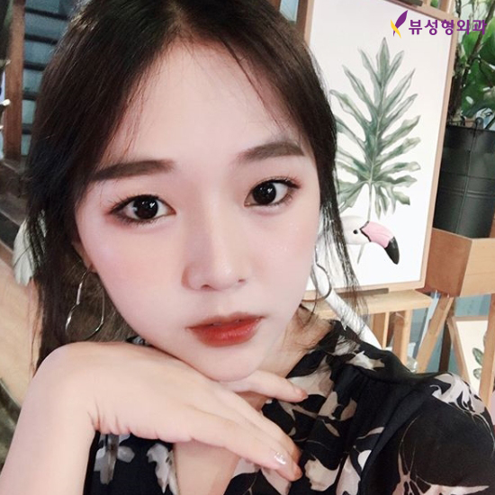 주걱턱수술, 만족도 높은 결과를 위한다면? VIEW! 관련 이미지 4