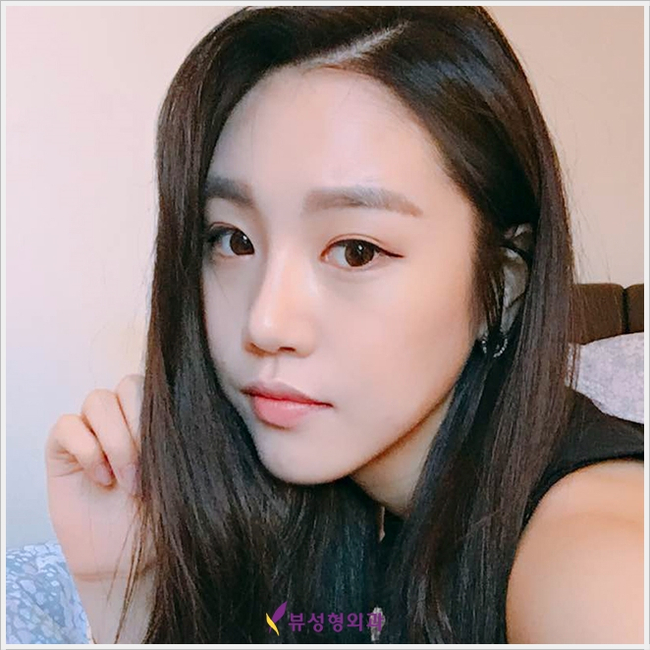 코성형 유의할 점은?(by 뷰성형외과) 관련 이미지 7