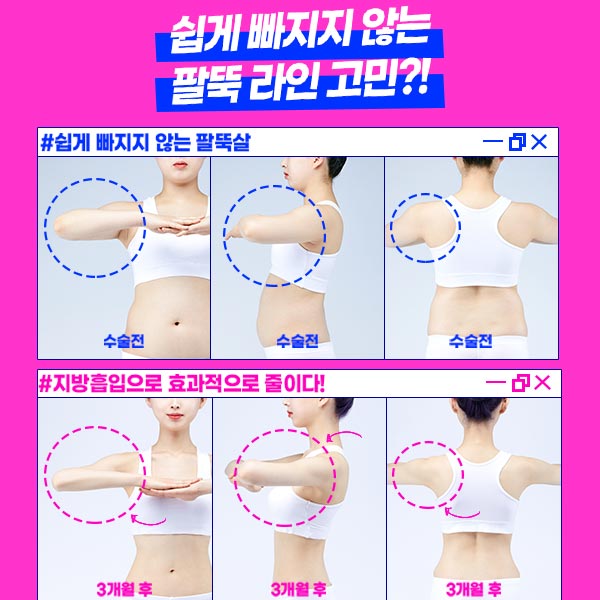 팔뚝살지방흡입 자연스럽고 조화로운 팔뚝을 원한다면 관련 이미지 5