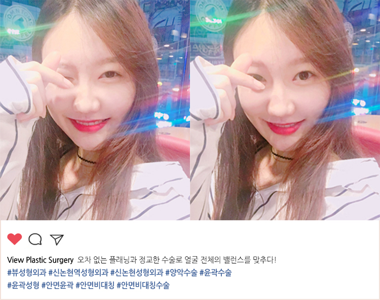 안면비대칭! 뷰에서 해결해봐! 관련 이미지 2