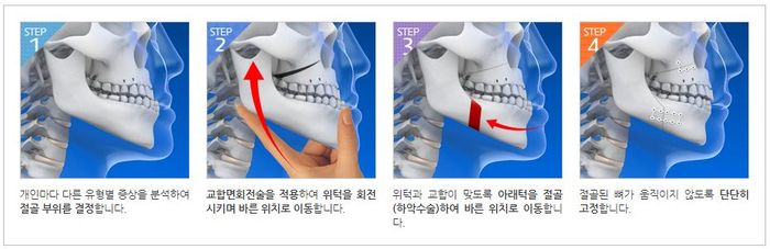 예뻐지는 수술? 양악수술의 올바른 정보 관련 이미지 6