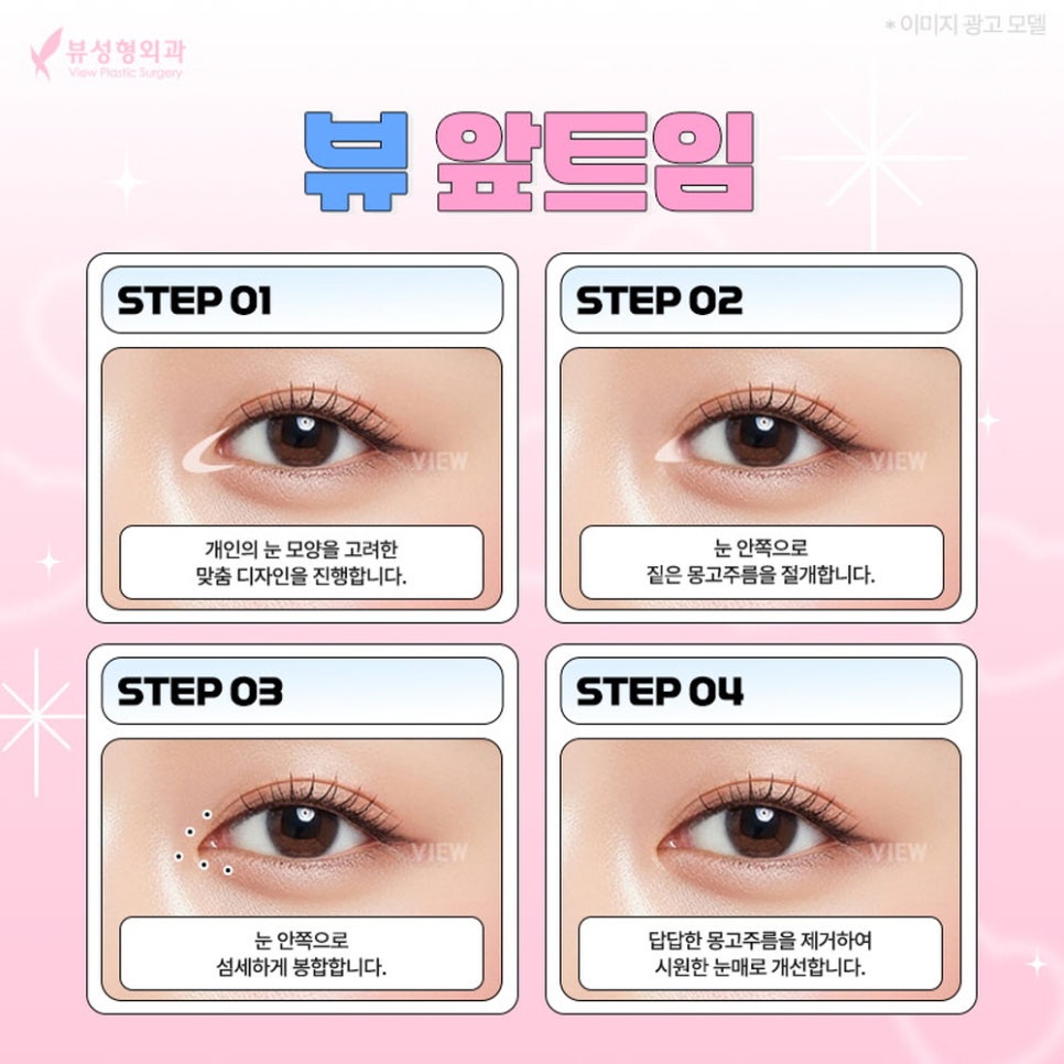 내게 맞는 눈성형 알아보기 관련 이미지 8