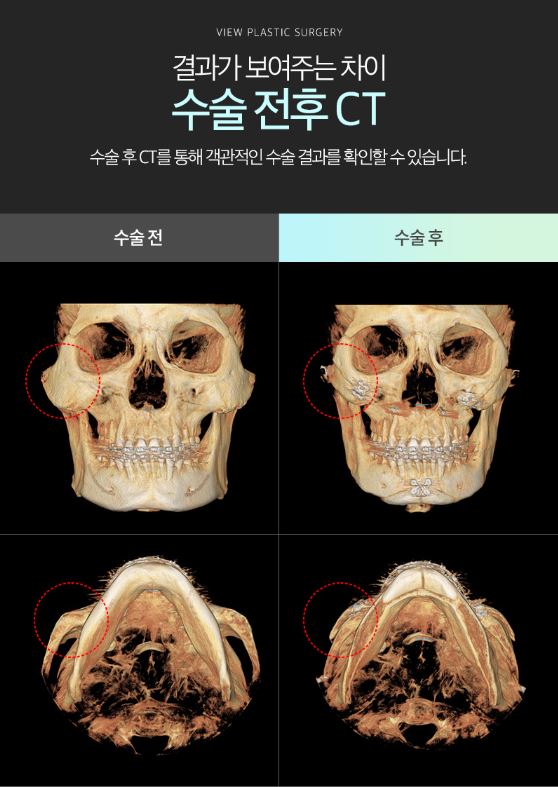 하이본 광대축소로 어느 각도에서나 갸름하게♥ 관련 이미지 6