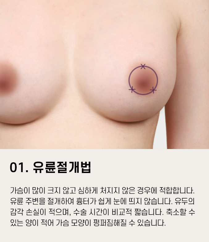 처진가슴수술 고민거리를 줄이고자 한다면 관련 이미지 10
