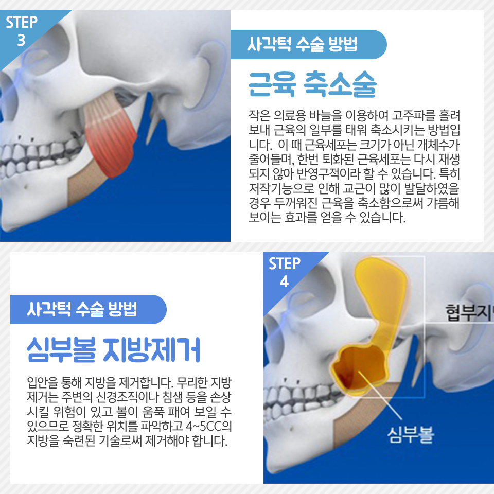 자연스럽게 윤곽잘하는곳 뷰성형외과 관련 이미지 7