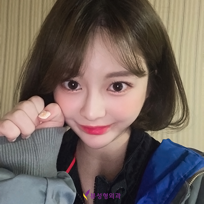 안검하수눈매교정 졸려보이는눈 해결해요 관련 이미지 10