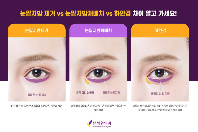 내게 맞는 눈성형을 위한 수술방법 관련 이미지 15