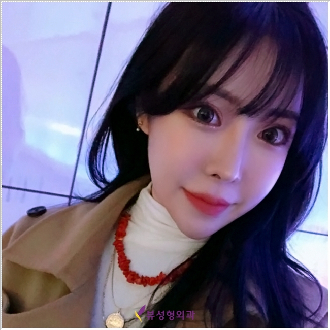 더 이상의 실패 없는, 뷰성형외과 코재수술 관련 이미지 4