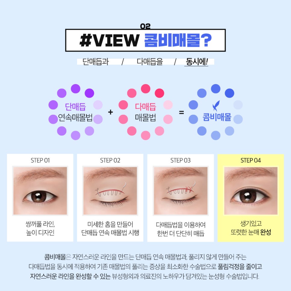 ☆여름 맞이 빠르게 찾아온 뷰성형외과 눈성형 이벤트☆ 관련 이미지 4