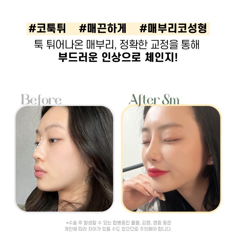 울퉁불퉁한 콧대를 매끈하게, 뷰성형외과 매부리코성형 관련 이미지 5