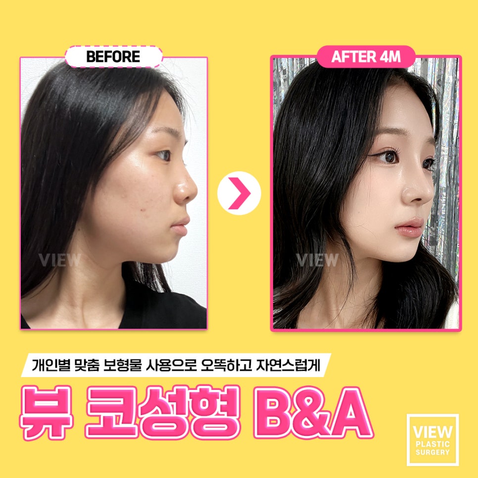 쑥쓰럽지만 궁금해요..코성형 Q&A 모음 관련 이미지 2