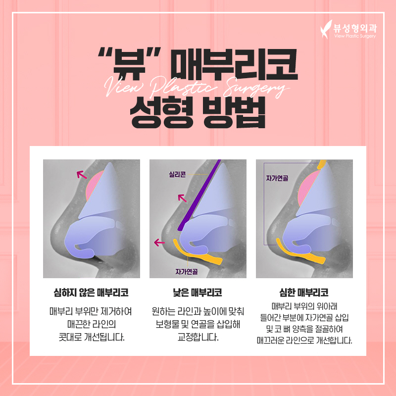 코성형, 개인별 유형에 적합한 수술방법은? 관련 이미지 15