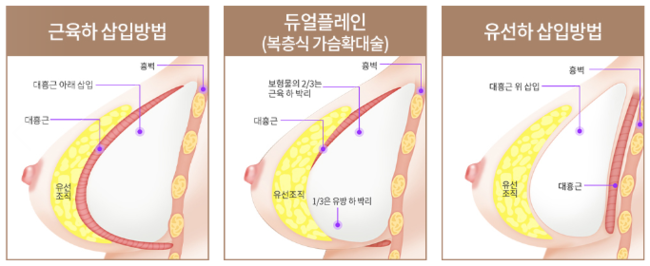 자연스런 가슴성형, 본인에게 적합한 보형물 및 절개방법 선택 중요 관련 이미지 5